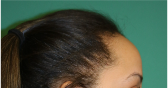 Hairline Lowering Surgery: Case 7 - Before