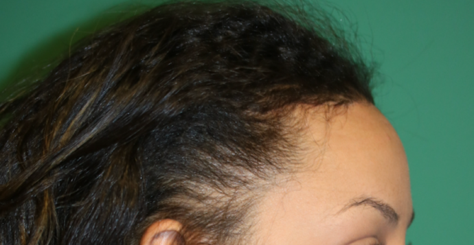 Hairline Lowering Surgery: Case 7 - After