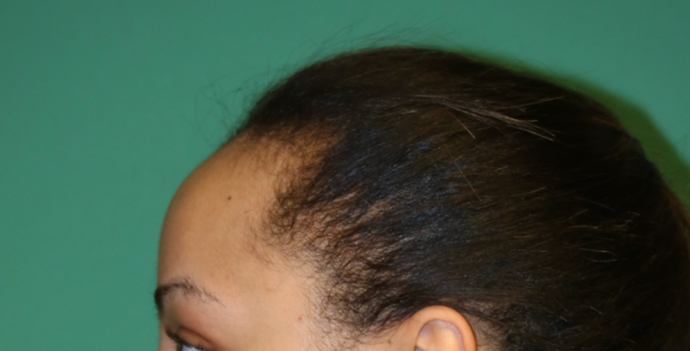 Hairline Lowering Surgery: Case 7 - Before