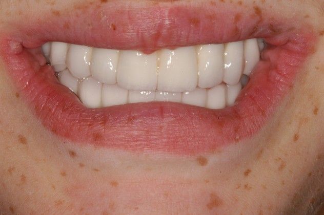 Cleph Palate Case Case