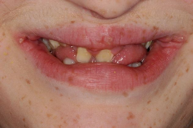 Cleph Palate Case Cleph Palate - Before