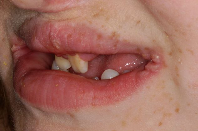 Cleph Palate Case: Cleph Palate - Before