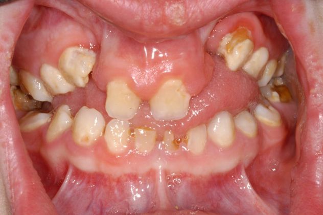 Cleph Palate Case: Cleph Palate - Before