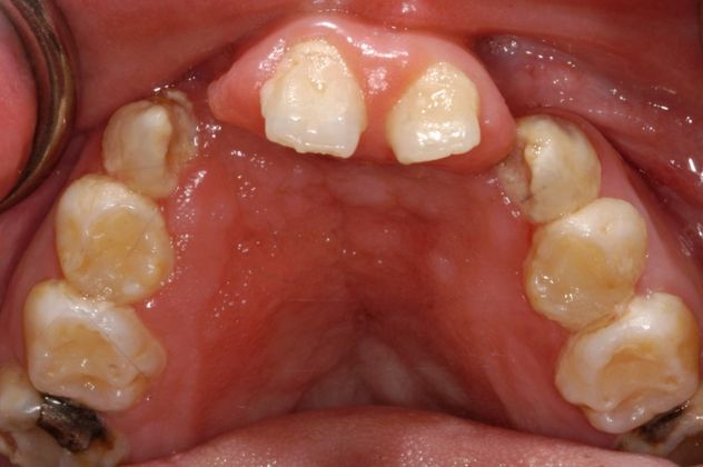 Cleph Palate Case: Cleph Palate - Before
