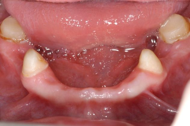 Cleph Palate Case: Cleph Palate - Before