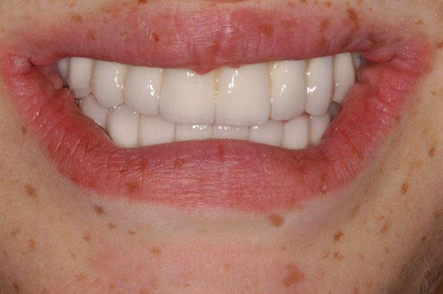 Cleph Palate Case Cleph Palate - After