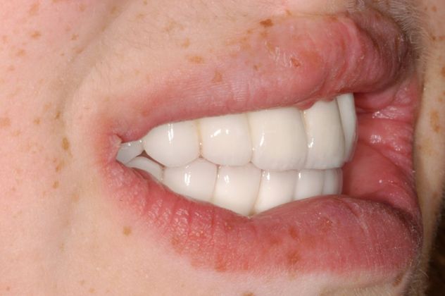 Cleph Palate Case: Cleph Palate - After