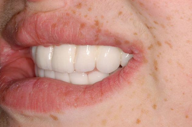 Cleph Palate Case: Cleph Palate - After