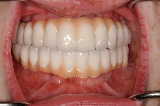 Cleph Palate Case: Cleph Palate - After