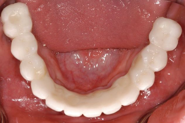 Cleph Palate Case: Cleph Palate - After
