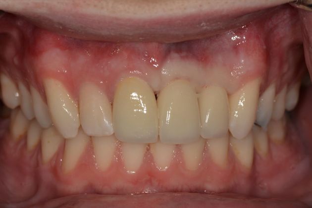 Dental Implants: Case 2 - After