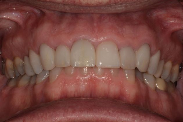 Crowns: Case 2 - Before