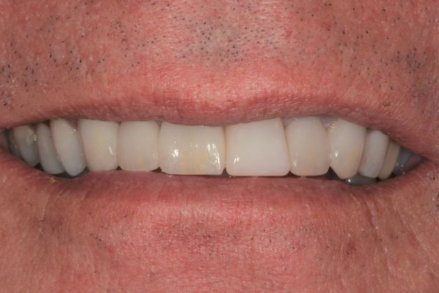 Crowns Case 2 - Before