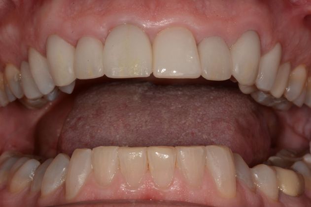 Crowns: Case 2 - Before