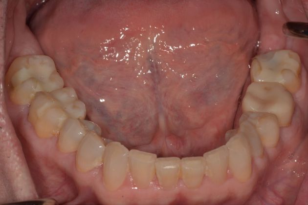 Crowns: Case 2 - Before