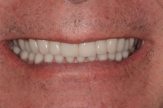 Crowns Case 2 - After