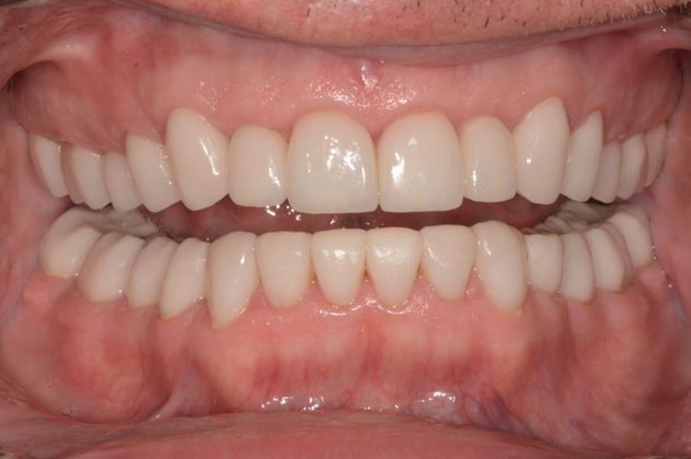 Crowns: Case 2 - After