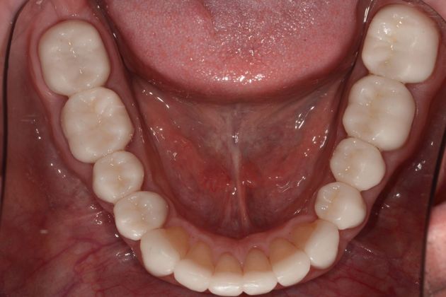 Crowns: Case 2 - After