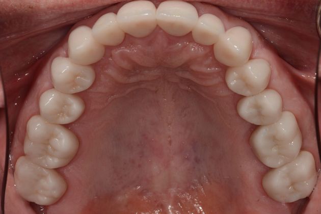 Crowns: Case 2 - After