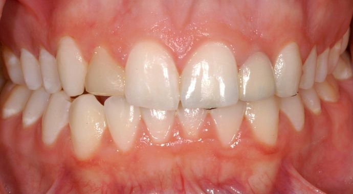 Case 1 - Congenitally Missing Teeth - Before and After Gallery