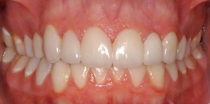 Congenitally Missing Teeth: Case 1 - After