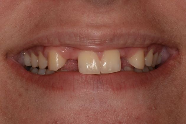 Congenitally Missing Teeth Case 2 - Before