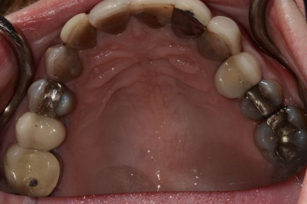 Wear Case: Case 1 - Before