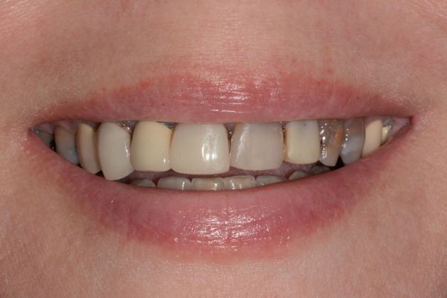 Wear Case Case 1 - Before