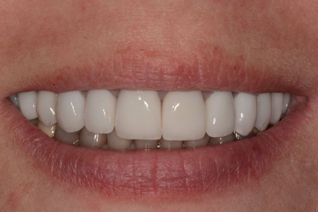 Wear Case Case 1 - After