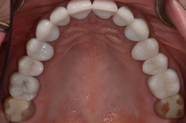 Wear Case: Case 1 - After