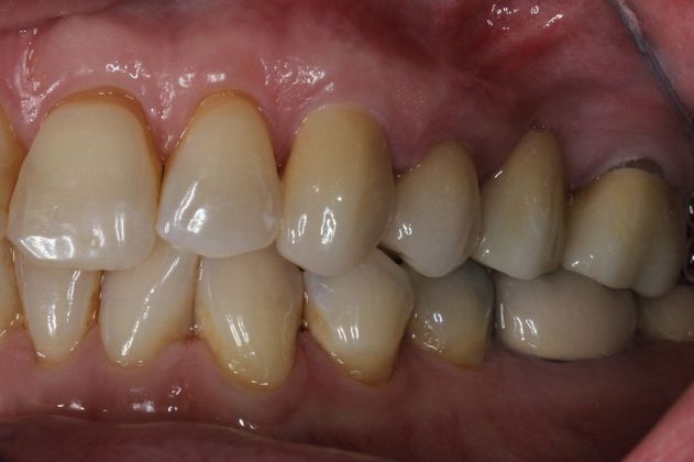 Bridges Failed Bridge to New Bridge - After