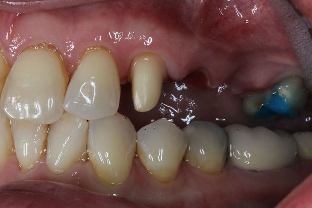 Bridges Failed Bridge to New Bridge - Before