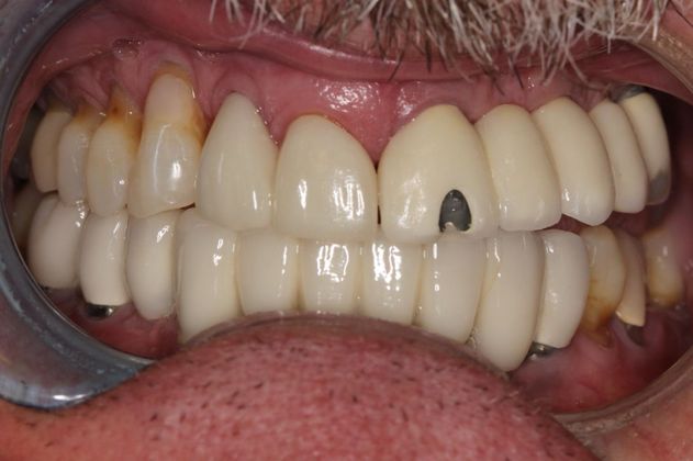 Bridges: Fixing an Implant Supported Bridge - Before