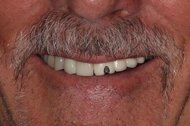 Bridges Fixing an Implant Supported Bridge - Before