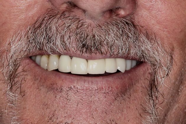 Bridges Fixing an Implant Supported Bridge - After