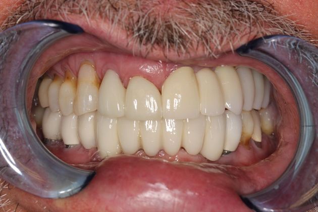 Bridges: Fixing an Implant Supported Bridge - After