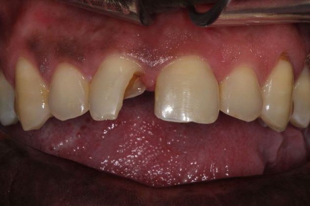 Fixing Chipped Teeth By Bonding - Bonding - Before And After Gallery