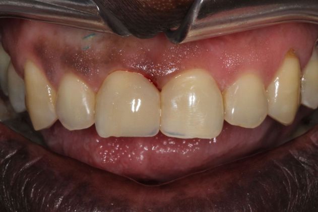 Bonding: Composite Bonding - After