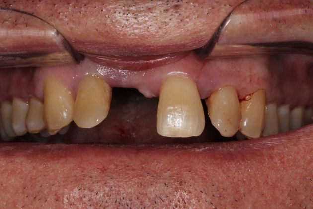 Bridges: Missing Front Teeth - After