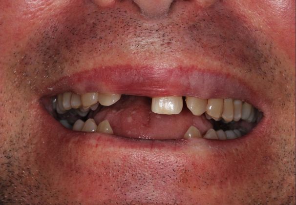 Bridges: Missing Front Teeth - Before