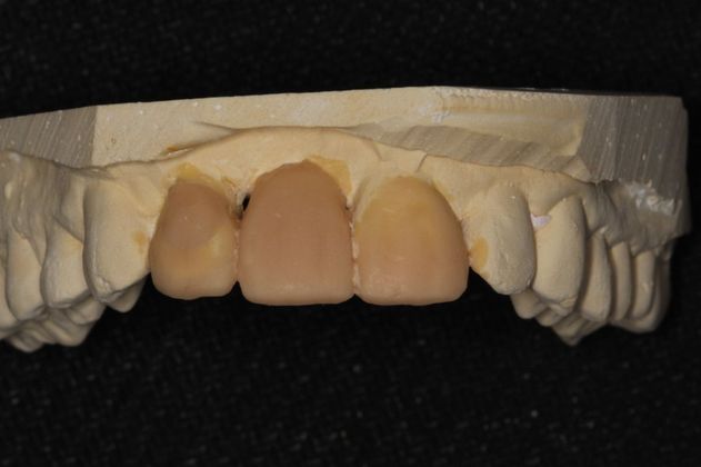 Bridges: Missing Front Teeth - Before