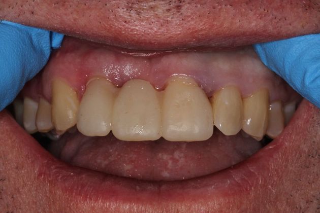 Bridges: Missing Front Teeth - After