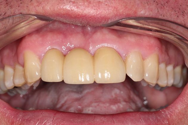 Bridges: Missing Front Teeth - After