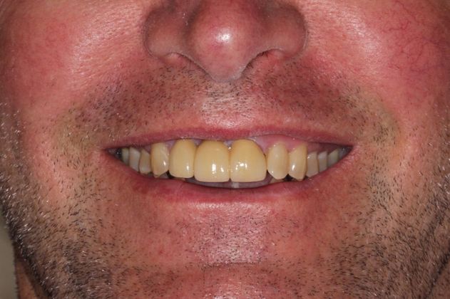 Bridges: Missing Front Teeth - After