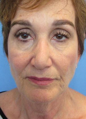 Facelift: Case 13 - Facelift, Greenwich - Before