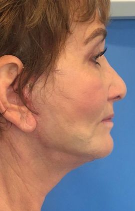 Facelift: Case 13 - Facelift, Greenwich - After