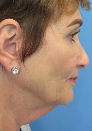 Facelift: Case 13 - Facelift, Greenwich - Before