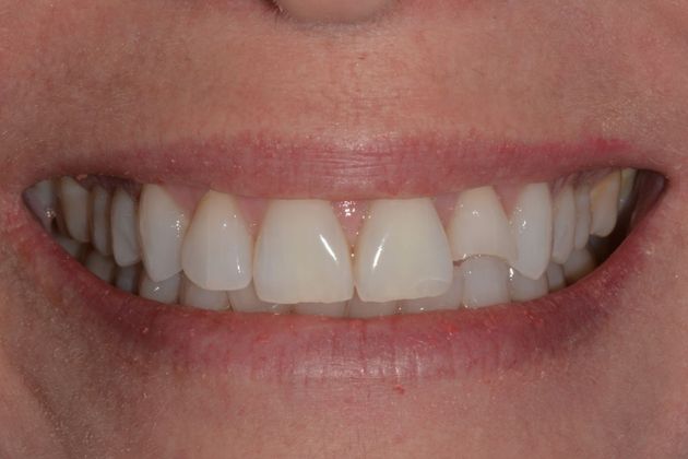 Bonding Case 1 - Before