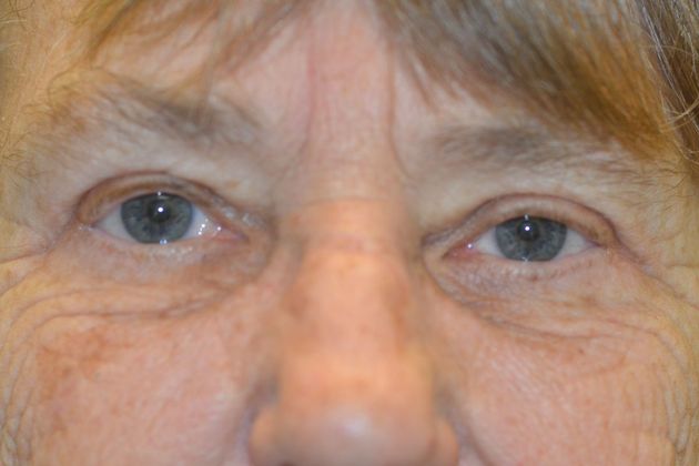 Upper Eyelid Blepharoplasty Case 32 - After
