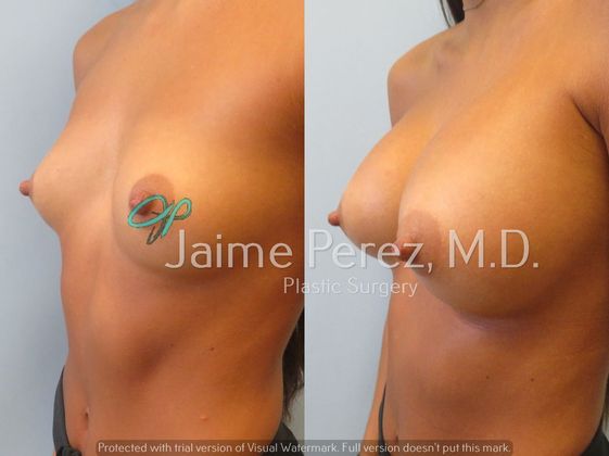 Before & After